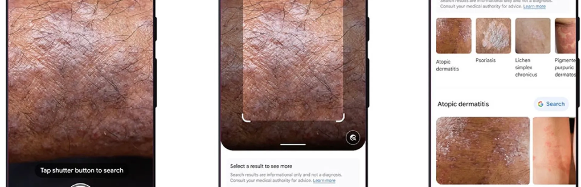 Avec Google Lens, votre smartphone identifie les problèmes de peau