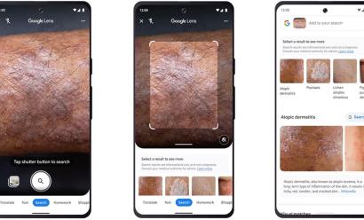 Avec Google Lens, votre smartphone identifie les problèmes de peau